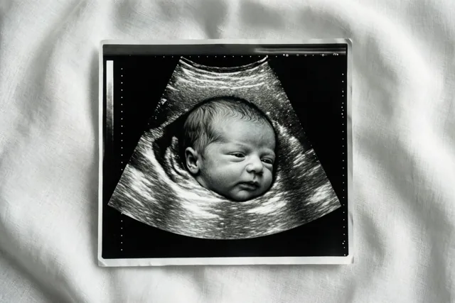 Een zwart-witte echofoto van een babygezicht ligt op zacht wit linnen, met een korrelige structuur en een driehoekig beeldkader rond het hoofdje.